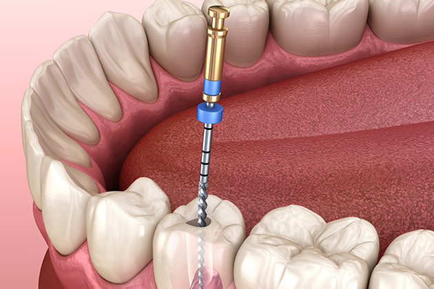 根管治療のメリット
