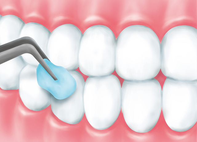 仕上げに歯面を強化するフッ素を塗布します​