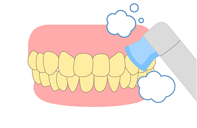 STEP.02 歯面清掃