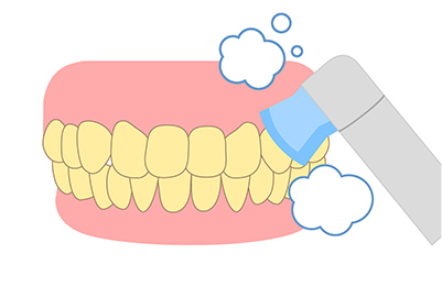 STEP.02 歯面清掃